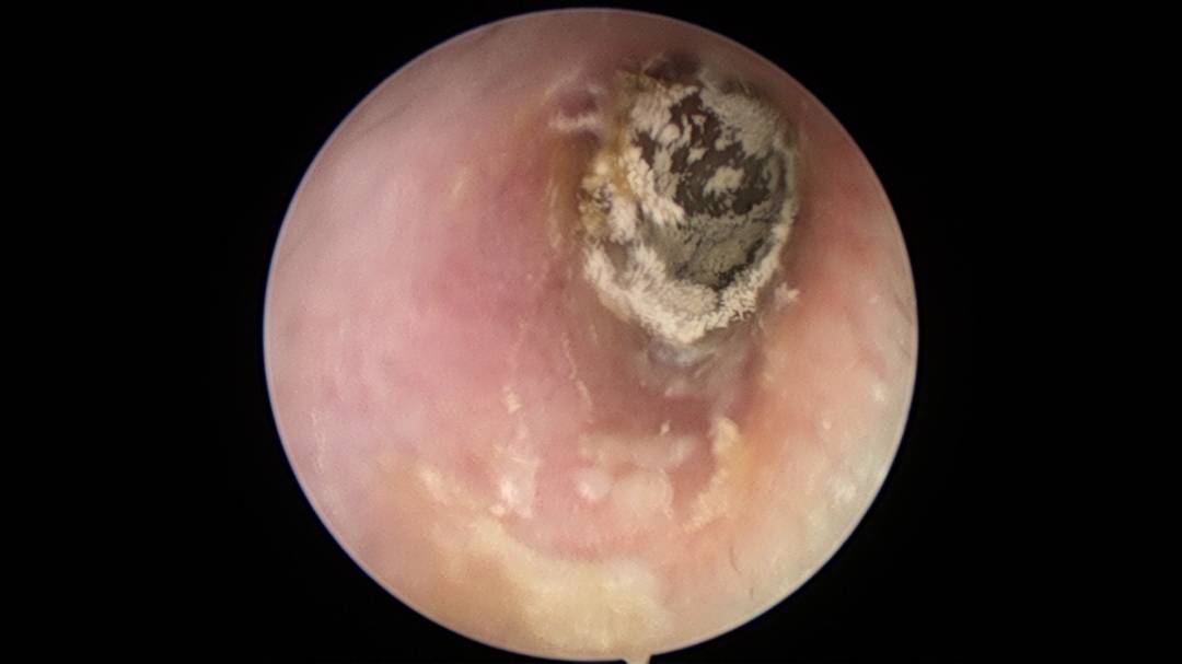 北京耳科医生申力耳朵为什么总会发痒你知道耳朵会长霉菌吗