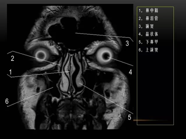 mri下眼部及鼻窦解剖图谱