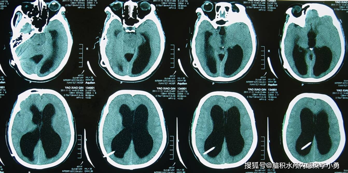 后颅窝枕大池蛛网膜囊肿脑积水分流术后颅内感染右侧肢体和头部震颤