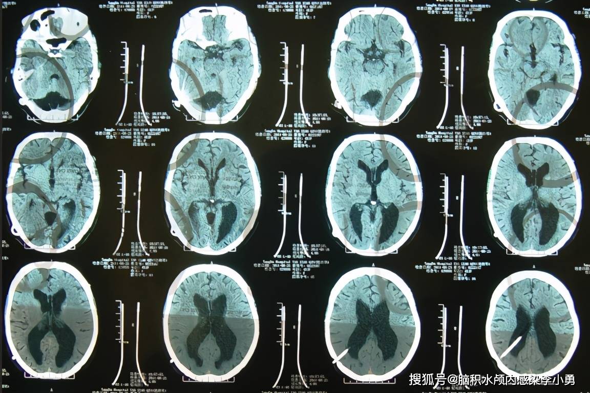 后颅窝枕大池蛛网膜囊肿脑积水分流术后颅内感染右侧肢体和头部震颤