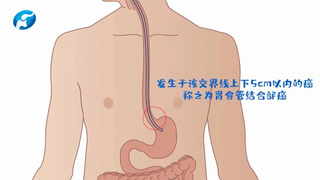 基于膜解剖理论指导下的贲门癌根治术——王国俊教授