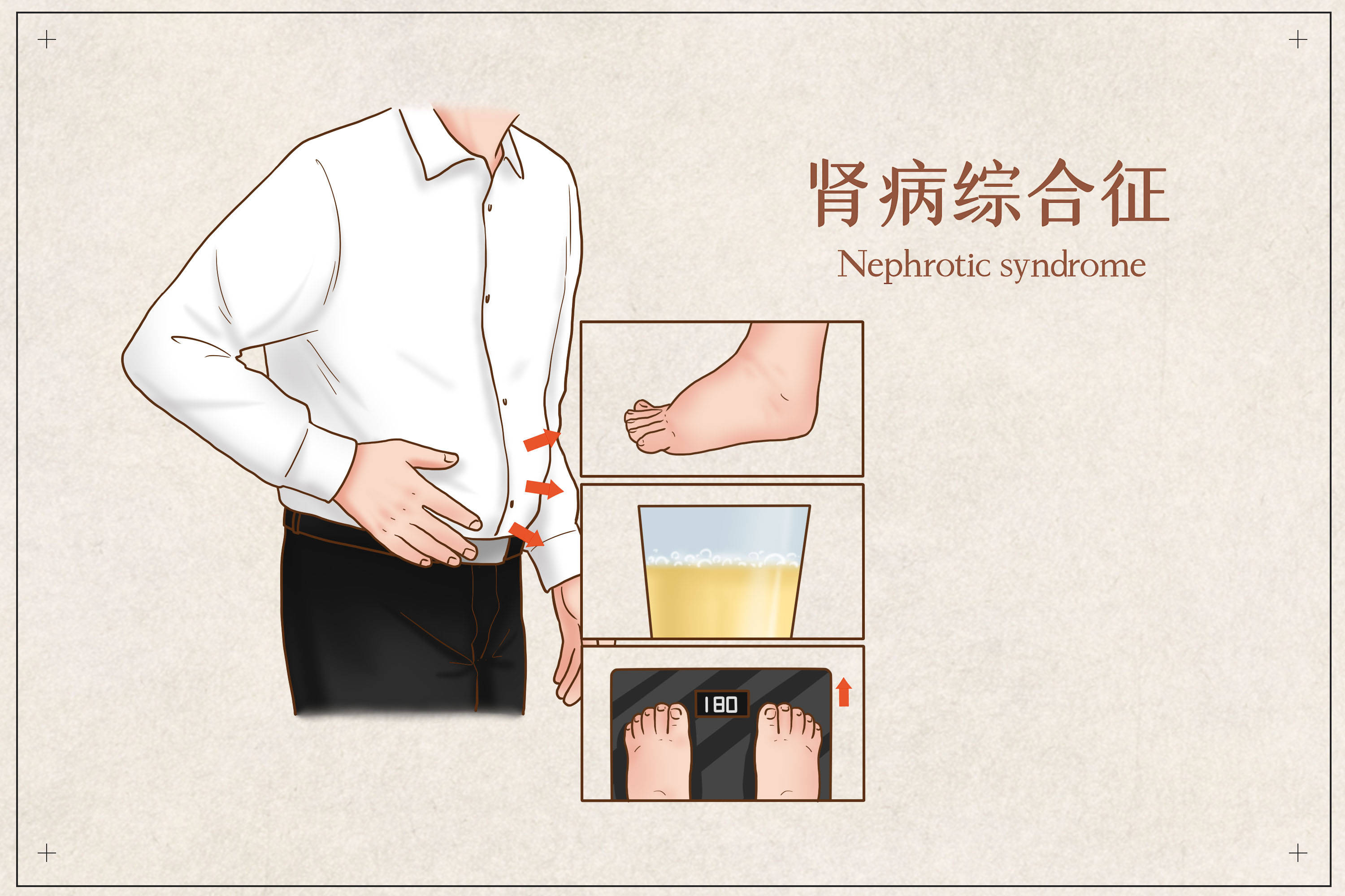 肾病是隐藏的流行病