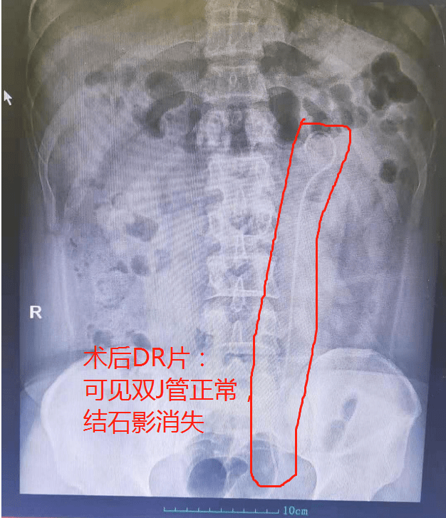 患者术后dr片:可见结石影消失,留置的双j管正常很多人不禁想问,是什么