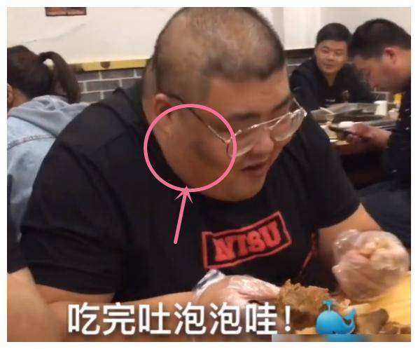 吃播泡泡龙去世网友曾说他脸颊处有黑斑是肝脏不好的表现应控制饮食