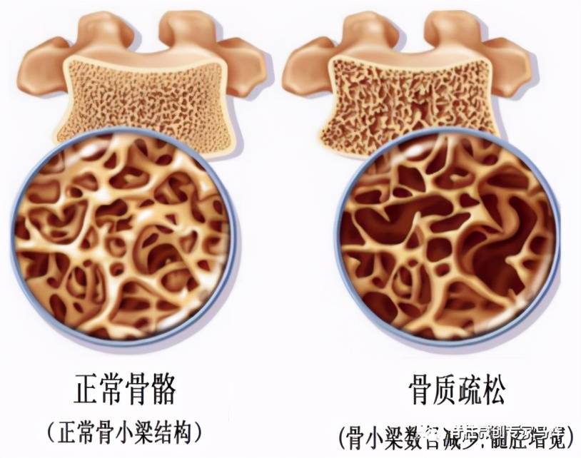 一失足成千"骨"恨,什么是老人骨质疏松性椎体压缩骨折?_脊柱