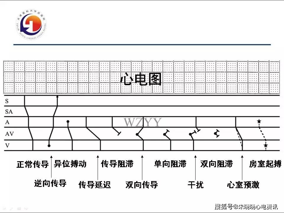 梯形图在疑难心电图诊断中的应用