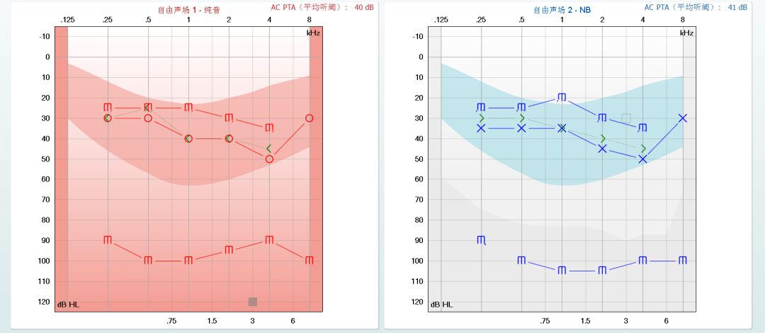 轻度听力损失患者的听力学干预方案