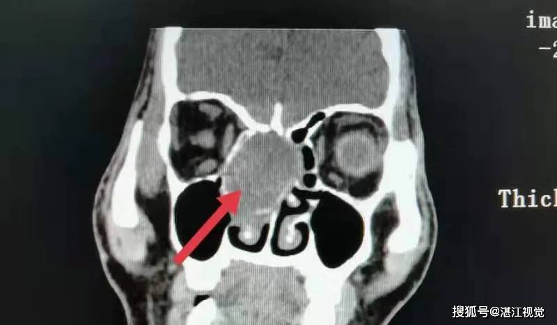 术前鼻窦ct冠位显示右侧筛窦肿物呈囊性膨胀性生长压迫鼻窦周围组织