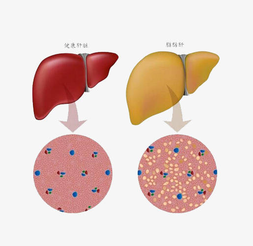 原创正确认识脂肪肝,脂肪肝不单是胖人的专利