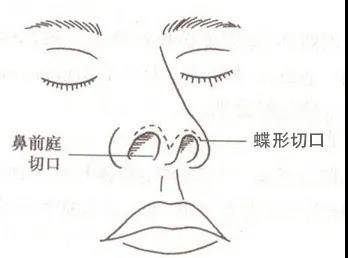 这种切口比较隐秘 不容易被看出来 在一侧鼻口内的顶部作一弧形切口