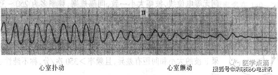 心室扑动,心室颤动