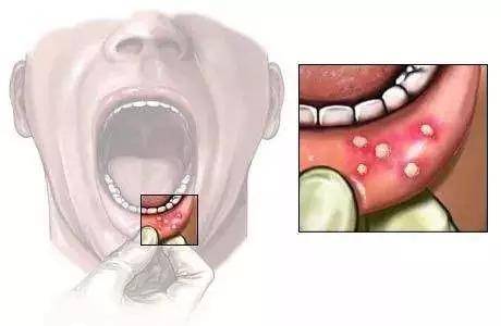 奇妍口腔抗菌液分享:为什么口腔溃疡反反复复?