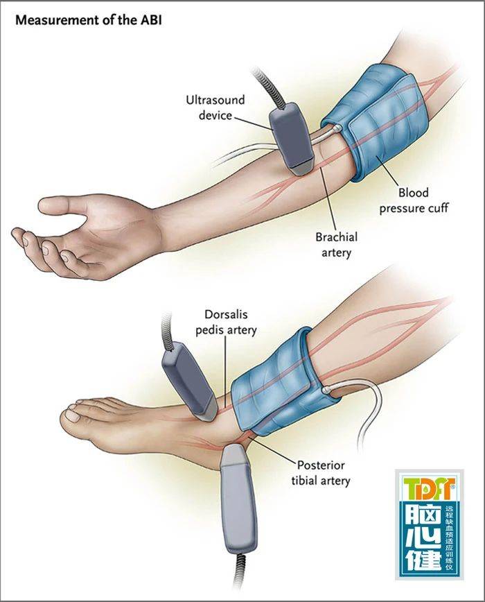 脑心健监护治疗仪|为什么要测量四肢血压,踝部血压怎么测量?