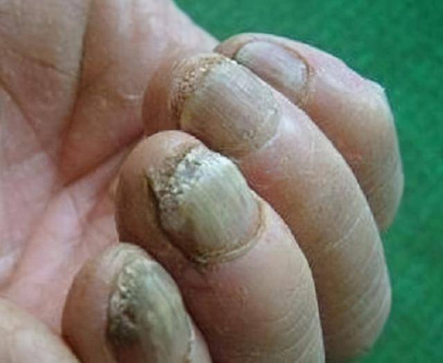 如:脚气,痱子,汗疮疹等,继而由于间接传染诱发灰指甲,所以该病在夏季