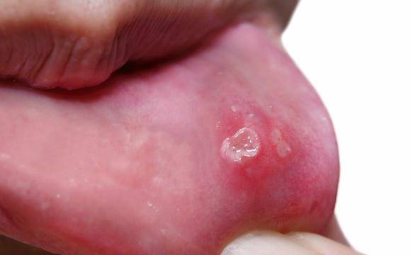 原创这些症状以为是溃疡提醒这或是舌癌的早期表现别忽视