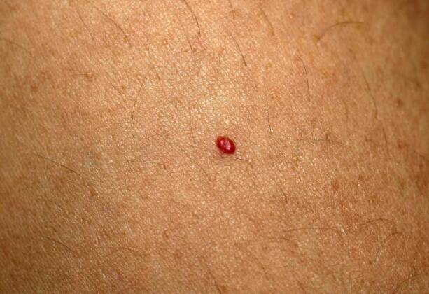 此时, 皮肤就会出现类似于蜘蛛一样的小红点,也叫"蜘蛛痣".