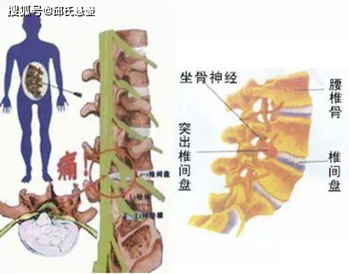 腰椎间盘突出压迫神经腿疼怎么治?邱氏悬壶