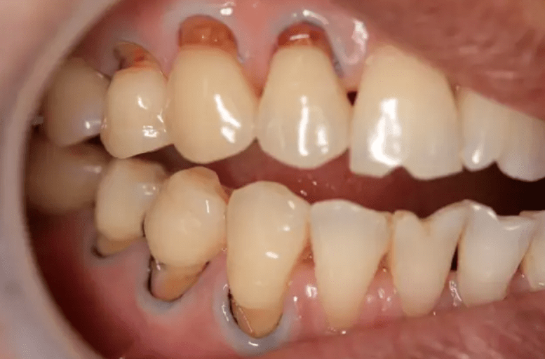 什么是楔装缺损 它是牙齿颈部被长期损耗形成的缺损 由于它外形酷似