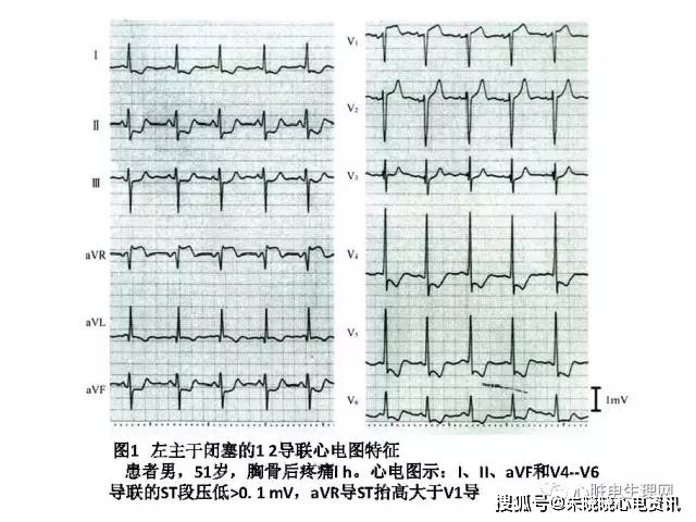左主干病变心电图
