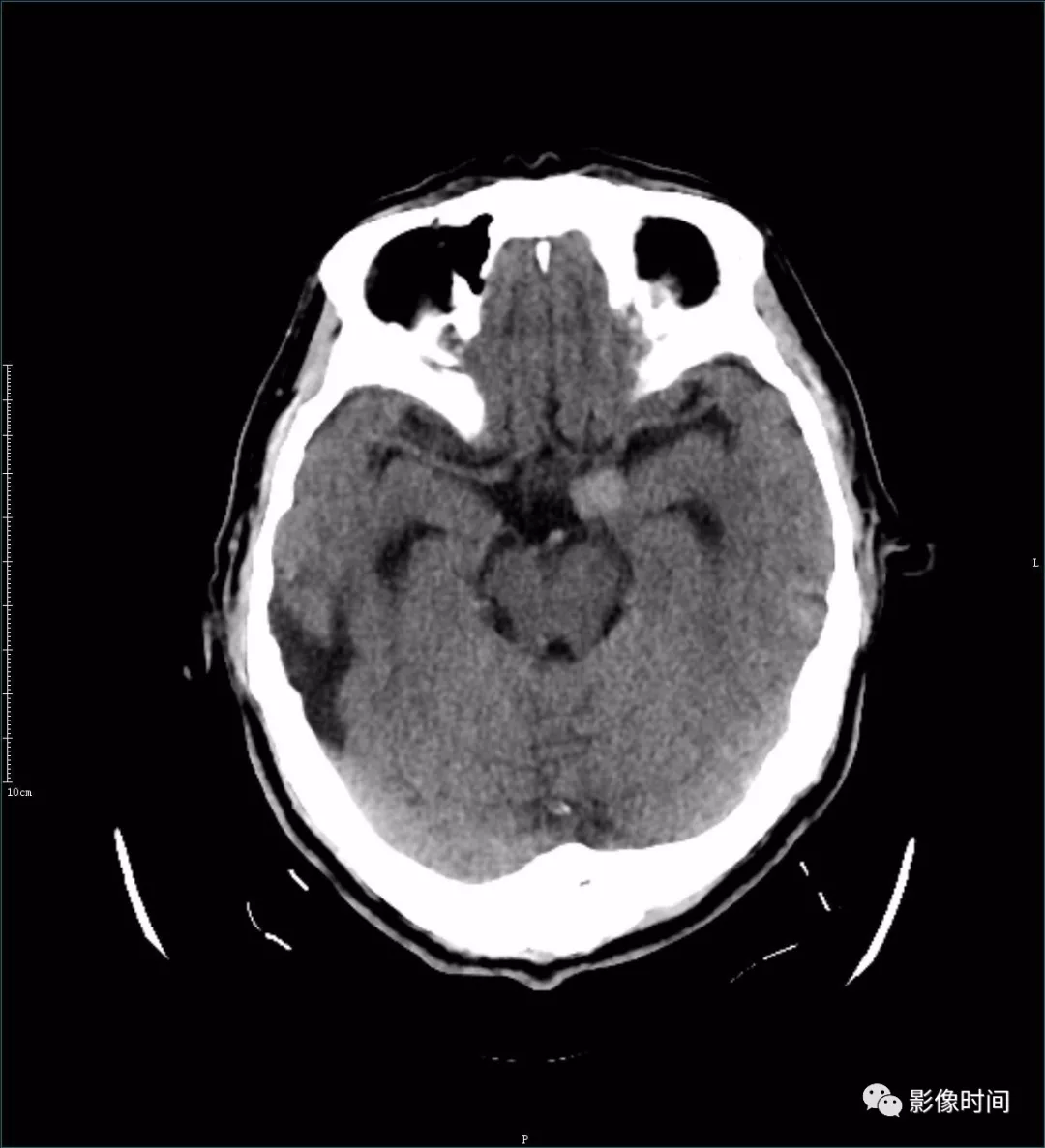 鞍上池类圆形高密度影,边界清晰 mri 平扫