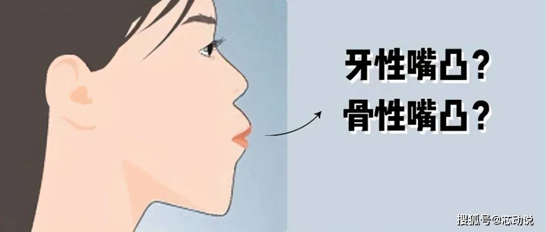 骨性嘴凸:轻微的骨性嘴凸可以通过矫正来改善,严重的则需要配合正颌