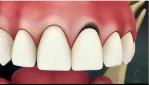 原创牙齿上冒出"黑线",先别着急用手抠,牙医专家教你这样做