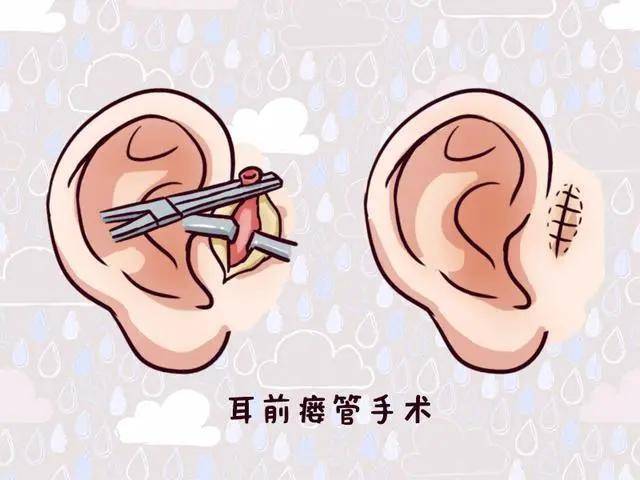 贵阳铭仁耳鼻喉医院:耳前瘘管是什么?快看你宝宝耳朵有这种小洞吗?