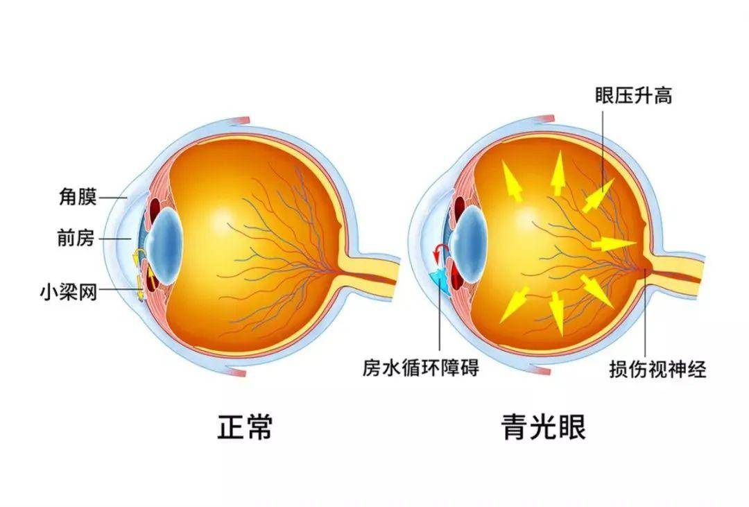 啥喝水也会引发青光眼