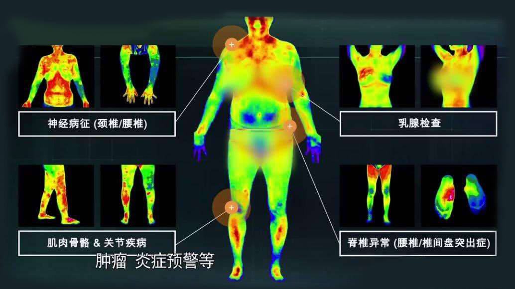 红外热成像技术让疼痛看得见_人体