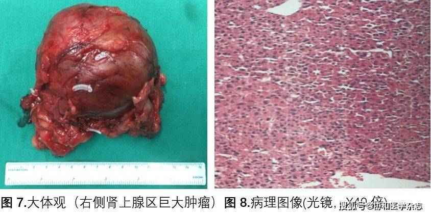 第二次多学科讨论泌尿外科:肾上腺皮质嗜酸细胞腺瘤,临床罕见肿瘤,大