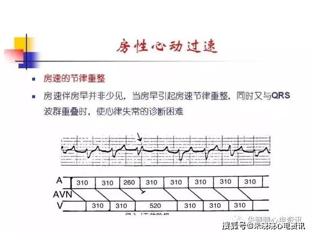 房速与房扑相关的心电问题