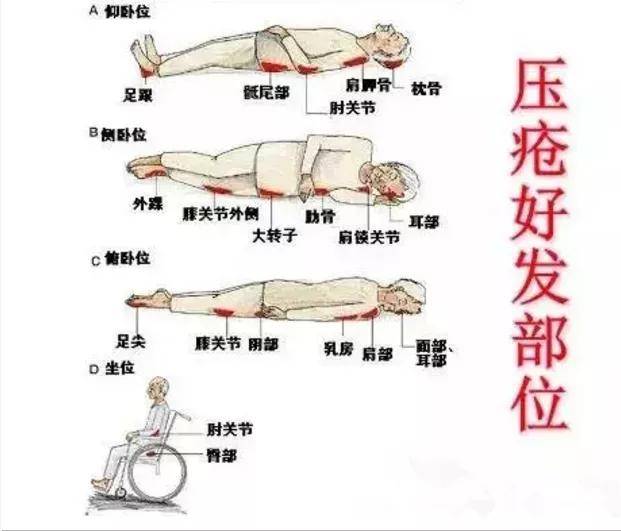 脑卒中偏瘫患者如何预防压疮
