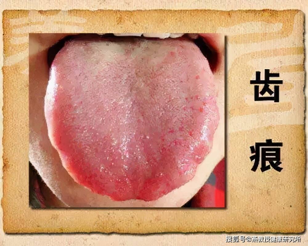 症状二:看舌苔一个人若是体内湿气过重,整个人看起来是比较慵懒的