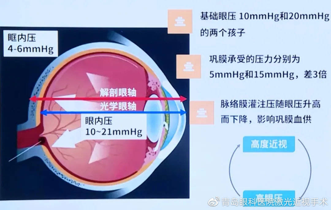 青岛眼科医院 重视眼压在孩子近视监控的作用