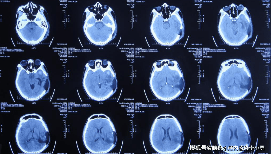 图-11:头颅ct:仍有皮下积液