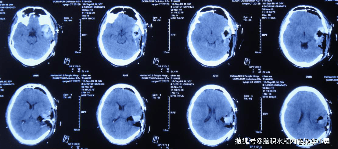 左颞脑动静脉畸形二次出血开颅术后颅内感染2月被脑