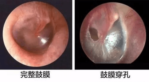贵阳铭仁耳鼻喉医院:掏耳朵也会导致鼓膜穿孔?这些细节你一定要知道!