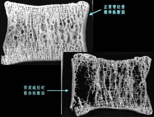一种以骨量低化,骨组织微结构破坏为特征,并导致骨脆性增加,易致骨折