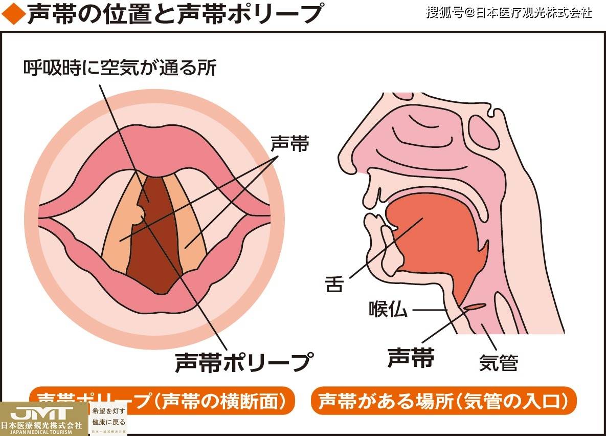 jmt日本医疗-由于喉咙过度使用而引起的声带息肉应如何防治