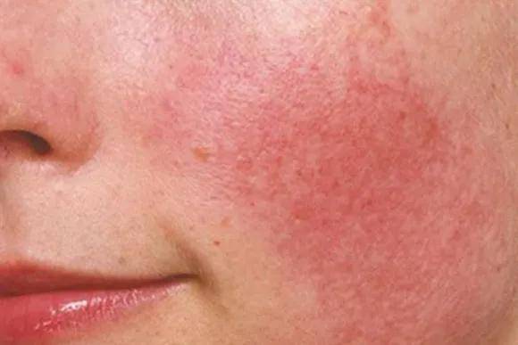 面部发红,发痒,发热是什么情况?广州市皮肤病防治研究