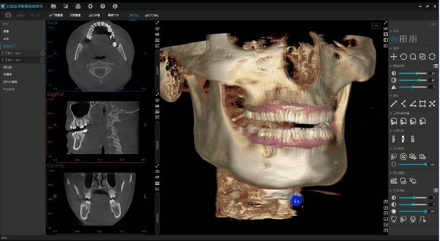美亚口腔cbct 口扫数据融合配准(部分图片来源于网络,如有侵权请
