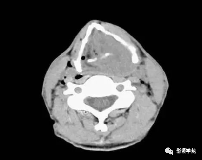 ct平扫见左半喉内软组织肿块,累及前,后联合,喉腔及喉旁间隙消失,左侧