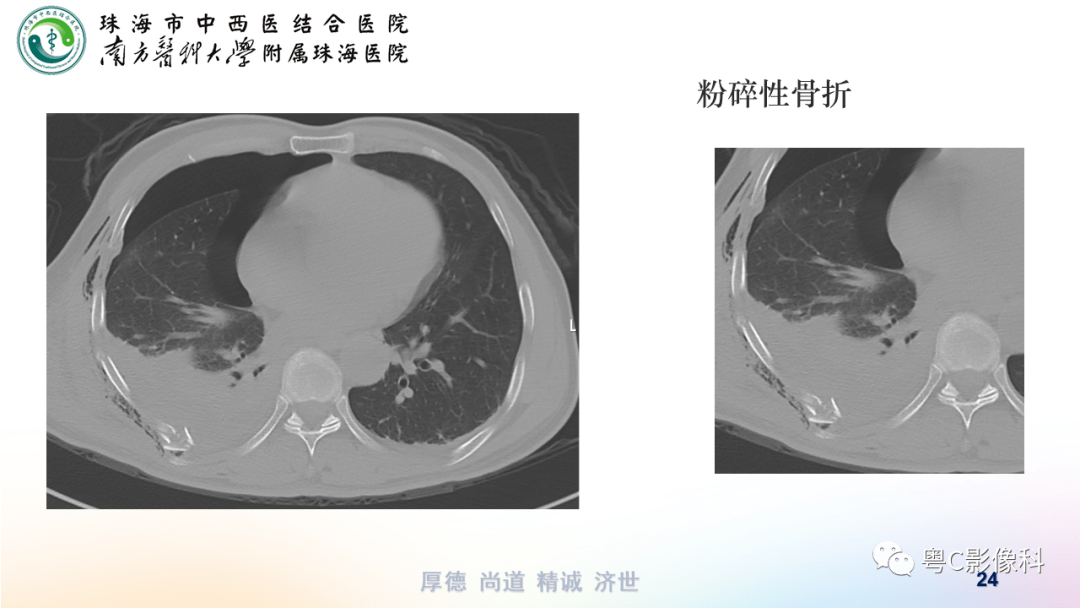 气胸,胸腔积液,肋骨骨折影像表现