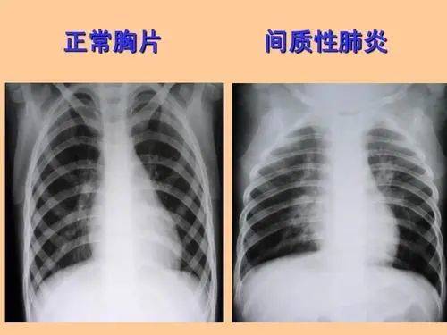 肺间质纤维化的形成原因和判定标准