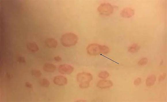 皮肤癣是指浅部真菌感染引起的皮肤病(传染性较强),包括皮肤的浅部