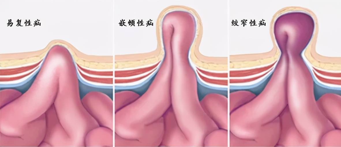 4,那小儿疝气如何治疗?