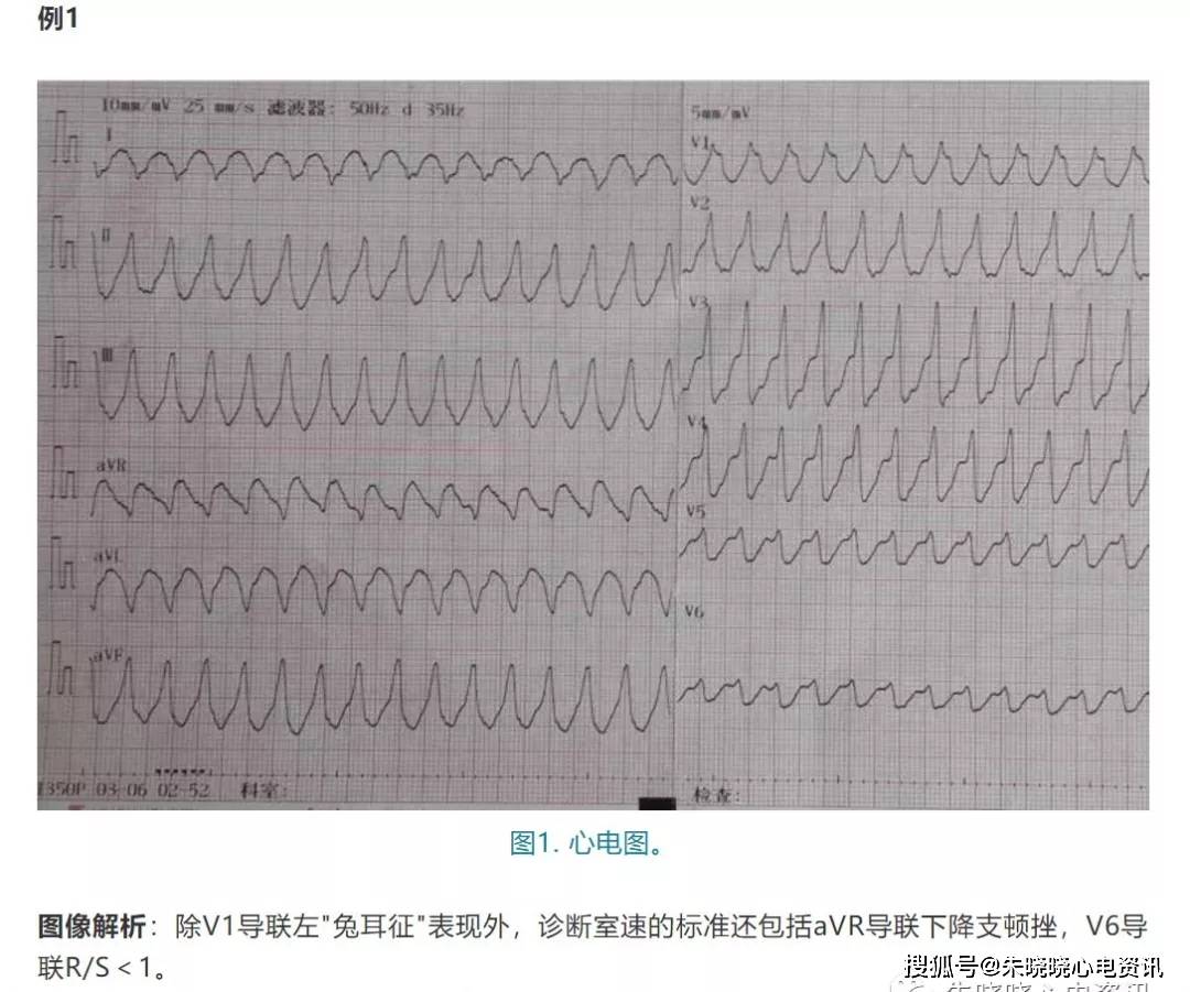 v1导联左"兔耳征"表现的室速_心电图