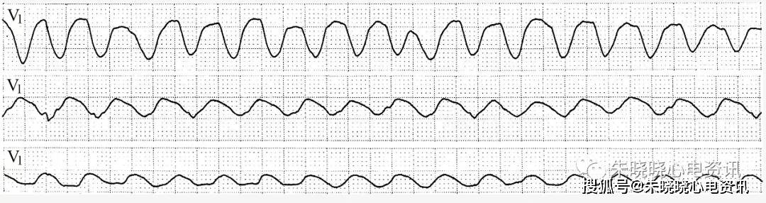 图7-14 心室扑动(上,中,下三行v1导联系同一患者相隔数分钟记录)