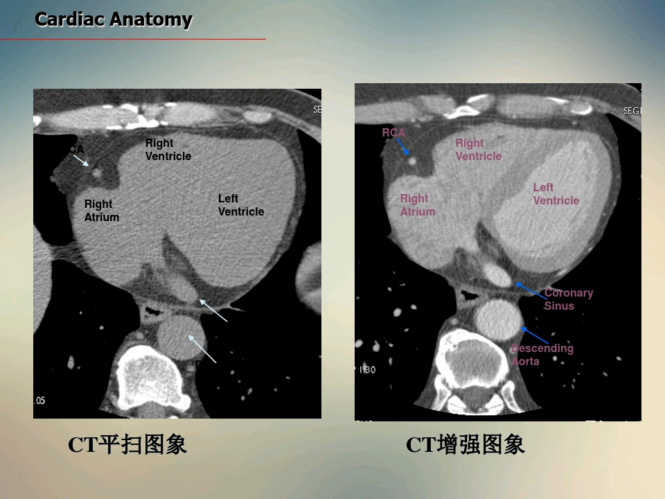 心脏ct断面解剖_平台