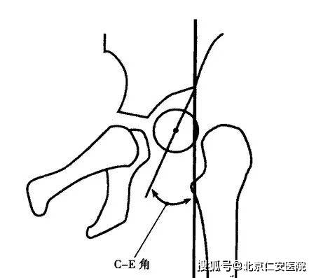 自股骨头旋转中心至髋臼顶的外缘画一直线,另自髋臼顶外缘作一垂线,两